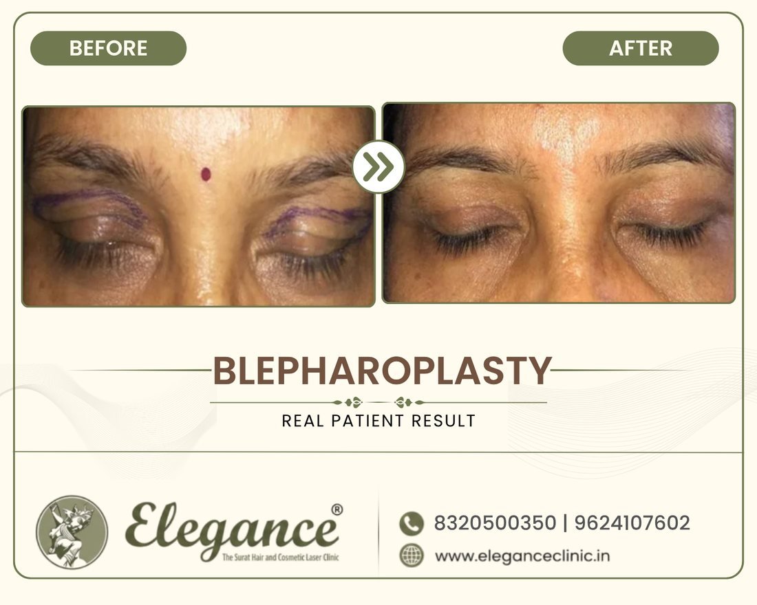 Blepharoplasty before and after result