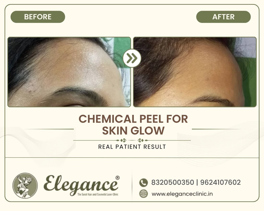 Chemical Peel Skin Glow before and after result