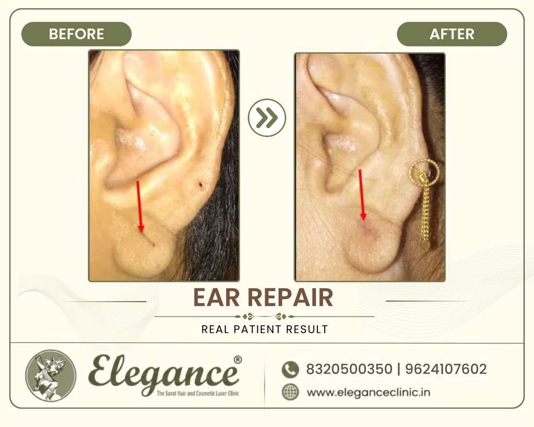 Ear Repair before and after result