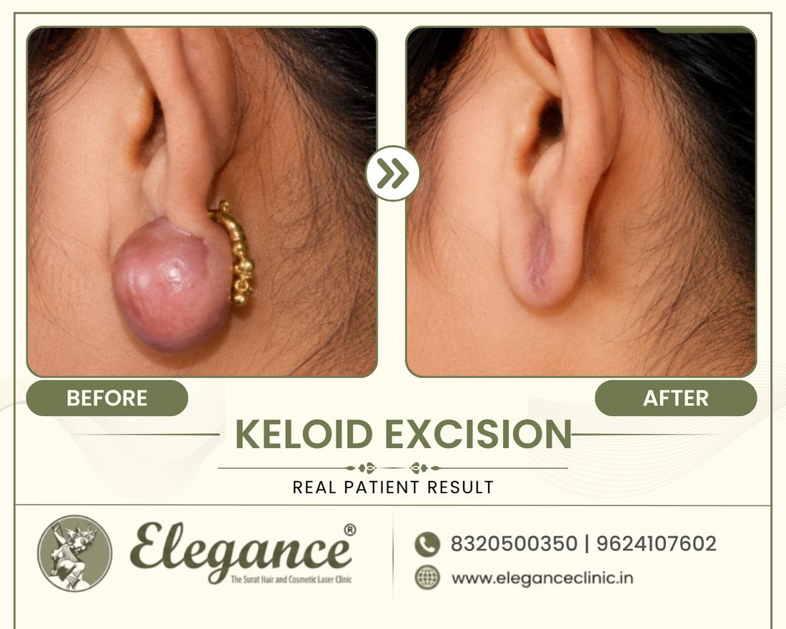 Keloid Excision before and after result