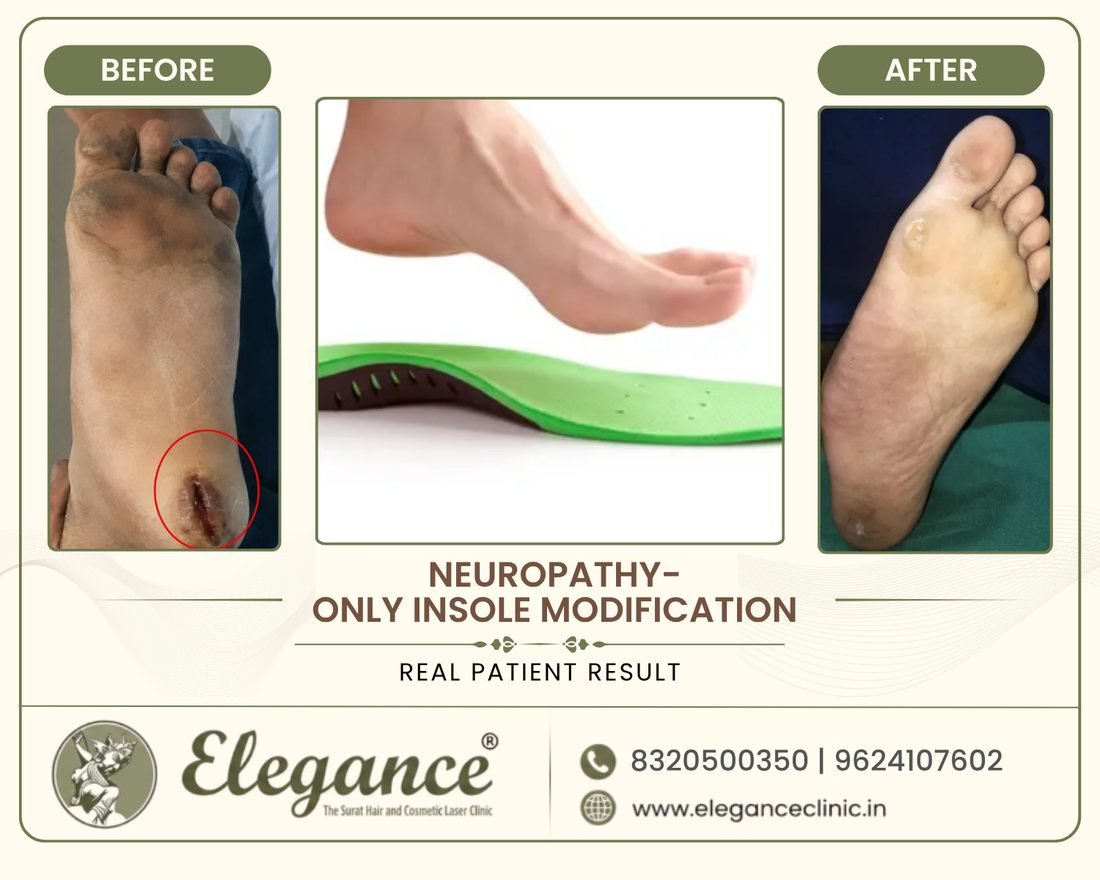 Neuropathy Insole Care before and after result