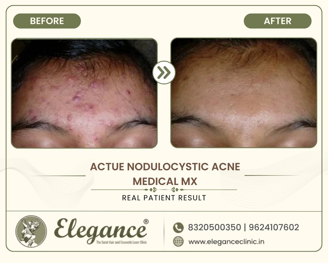 Nodulocystic Acne Treatment before and after result