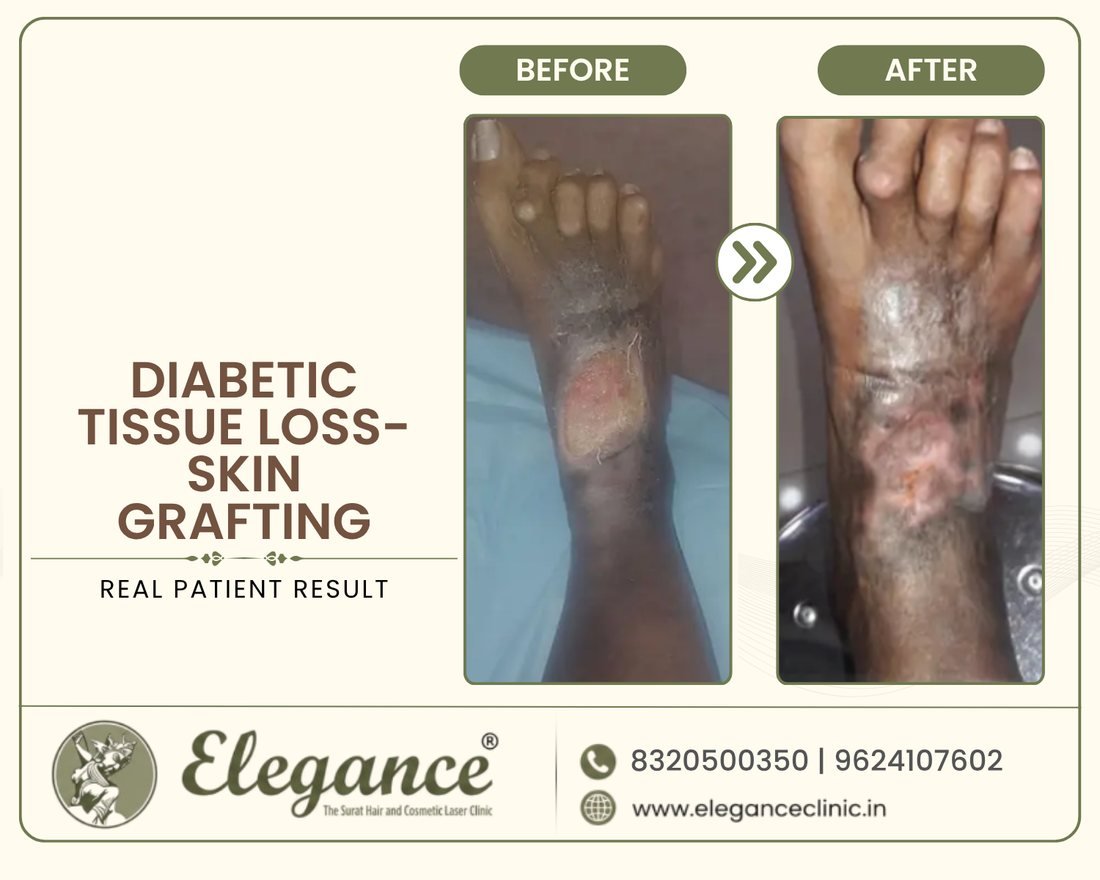 Skin Grafting before and after result
