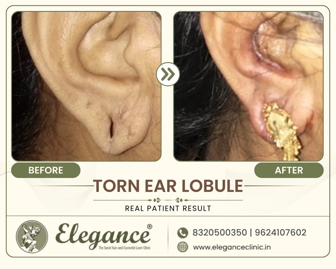 Torn Ear Lobule Repair before and after result