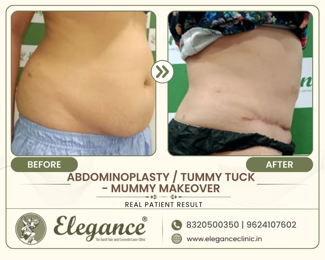 Tummy Tuck Mummy Makeover before and after result