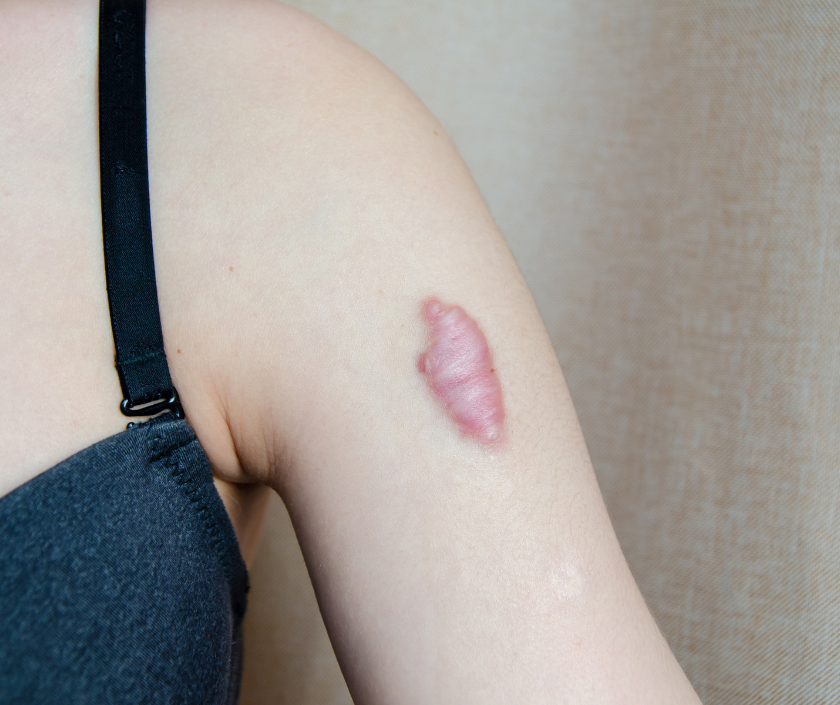 Keloid in Surat